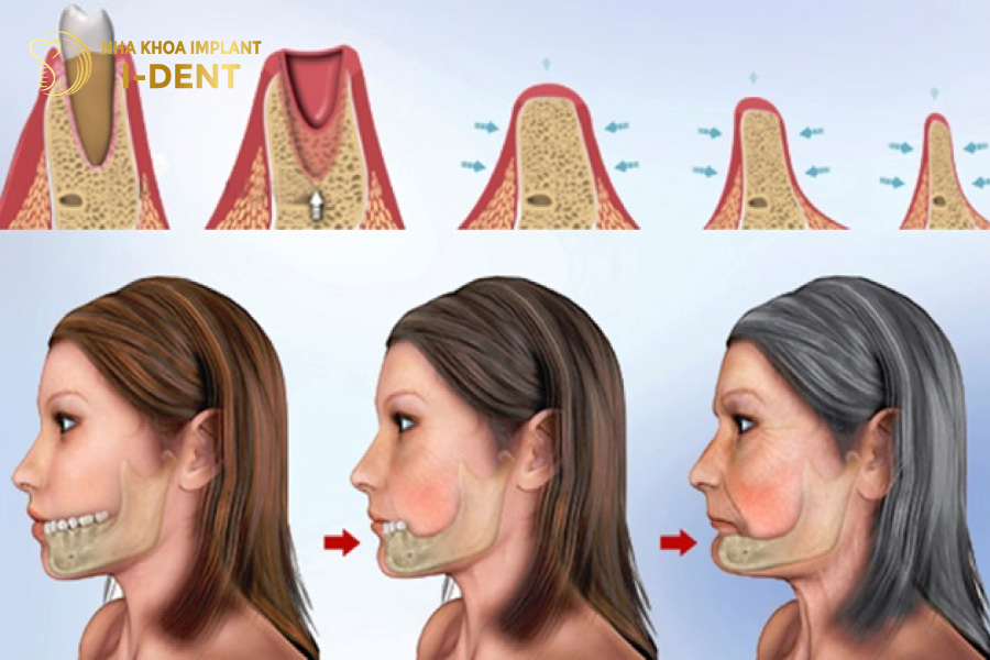 dấu hiệu tiêu xương răng