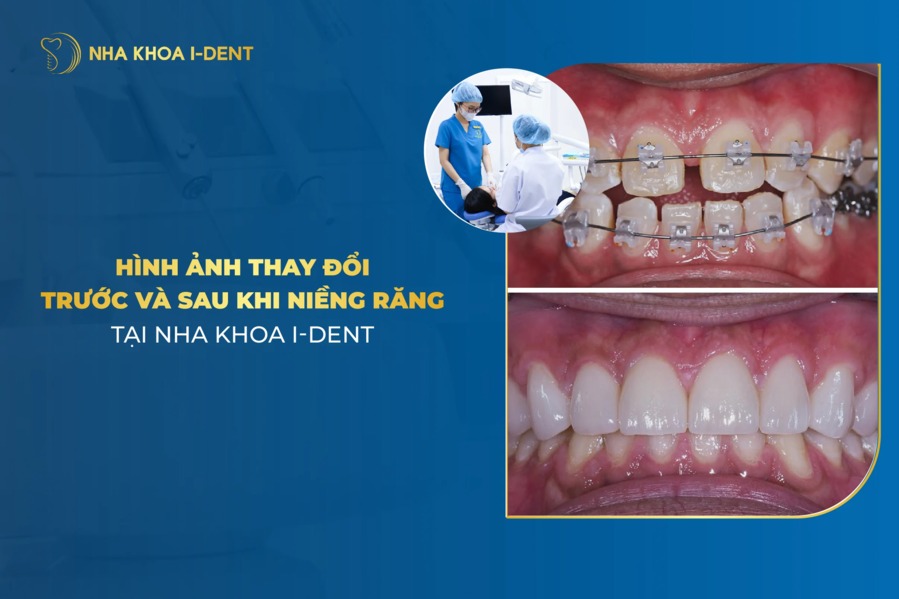 Hinh Anh Nieng Rang