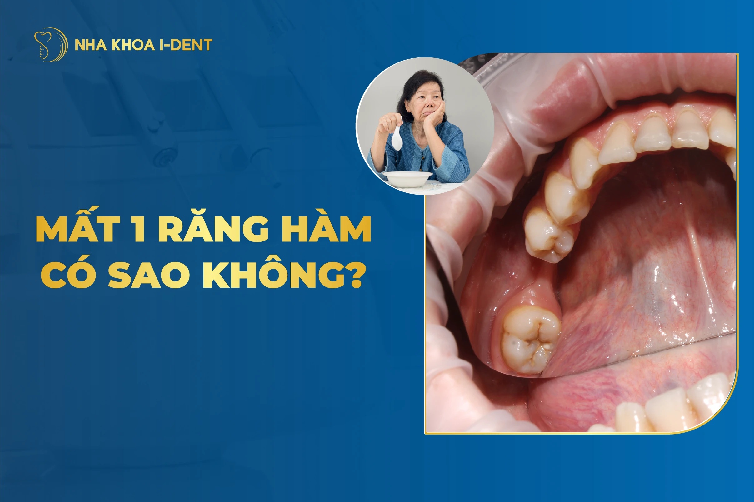 Mất Răng Hàm