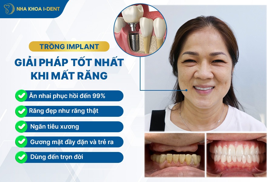 mất 2 răng hàm