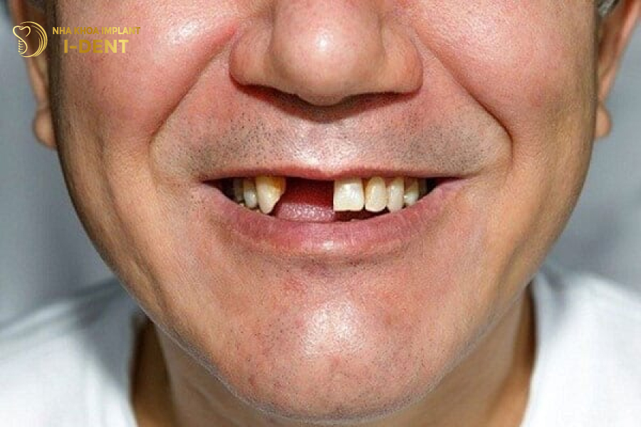 Nhổ răng bao lâu thì trồng lại được
