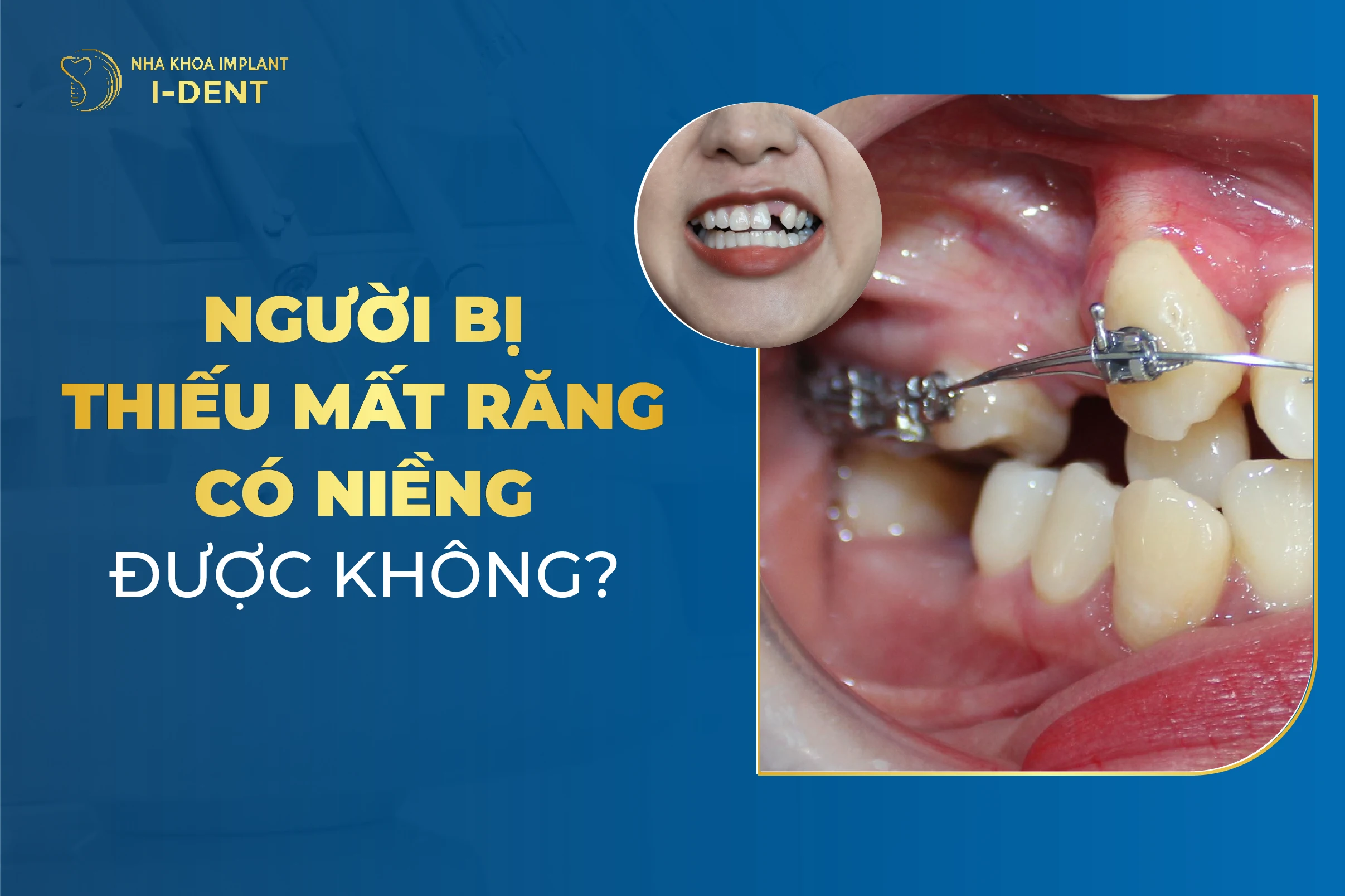 Mat Rang Co Nieng Duoc Khong 1