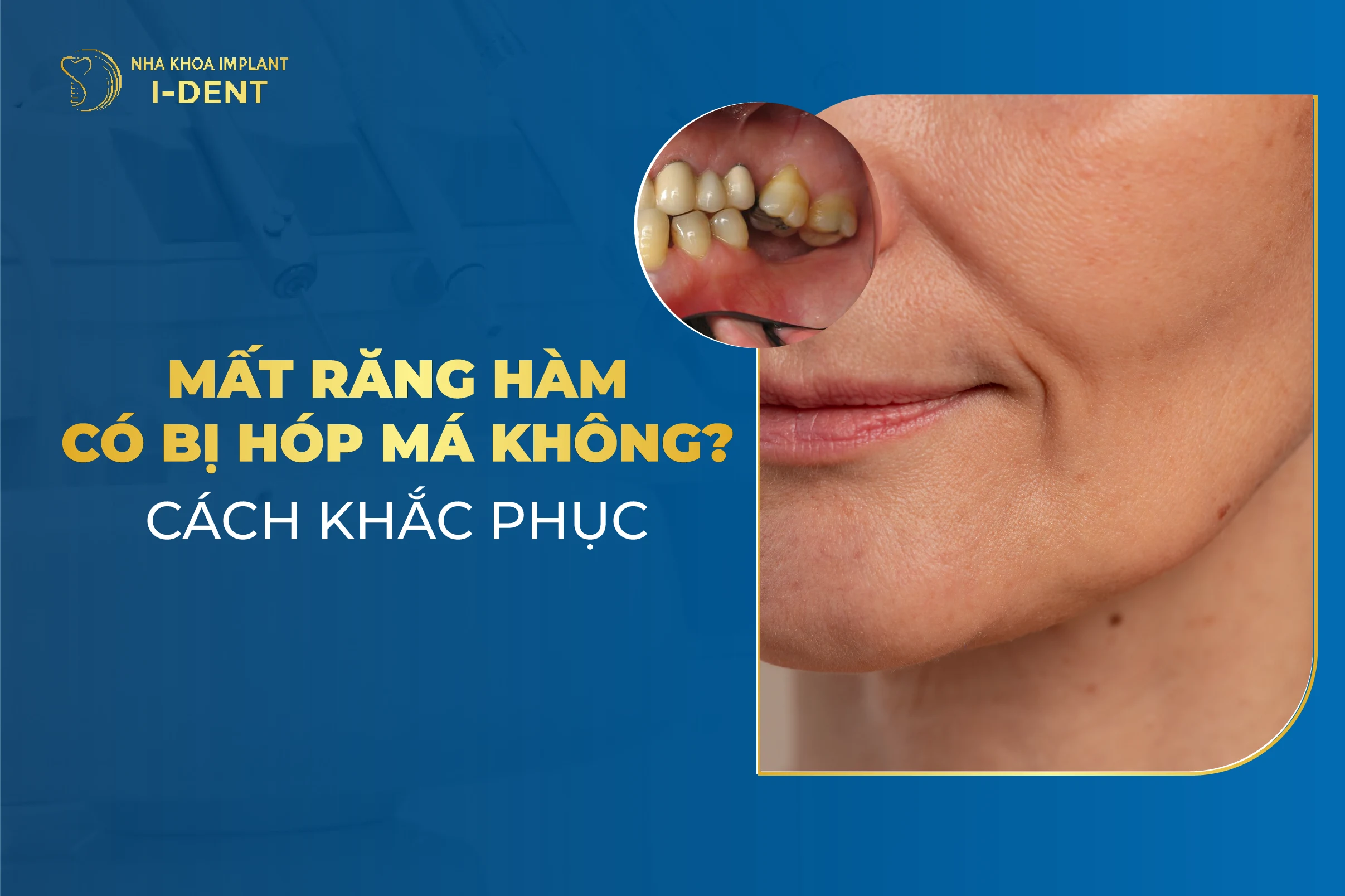 Mat Rang Ham Co Bi Hop Ma Khong