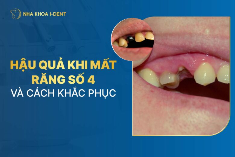 4 Hậu Quả Khi Mất Răng Số 4 Và Cách Khắc Phục