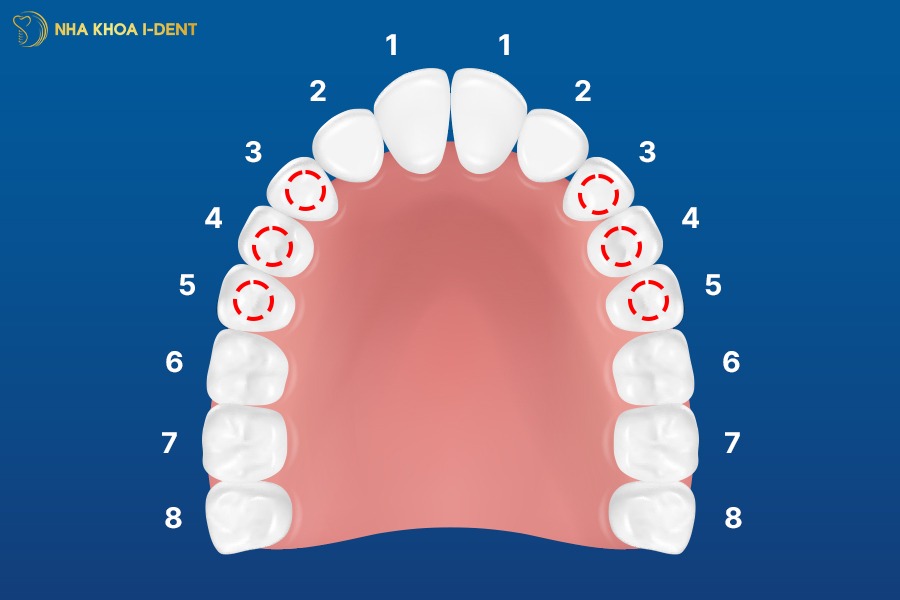 mất răng số 4