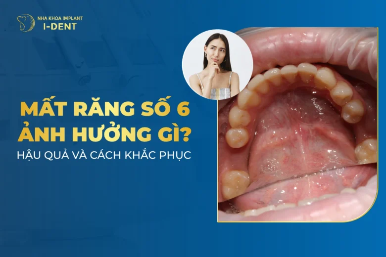 Hậu Quả Khi Mất Răng Số 6 Và Giải Pháp Phục Hình