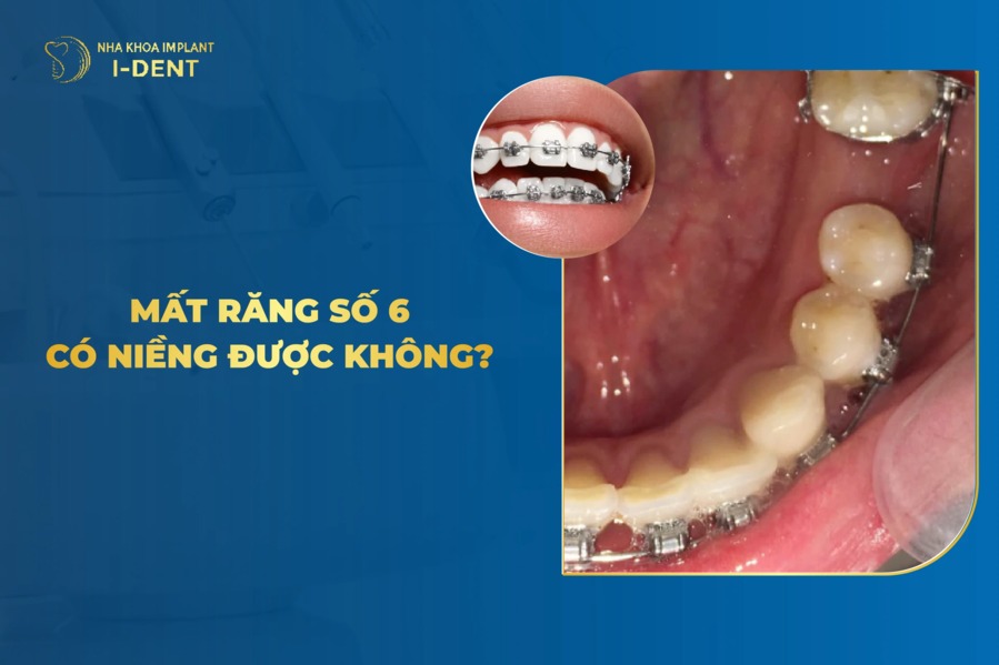 Mat Rang So 6 Co Nieng Duoc Khong