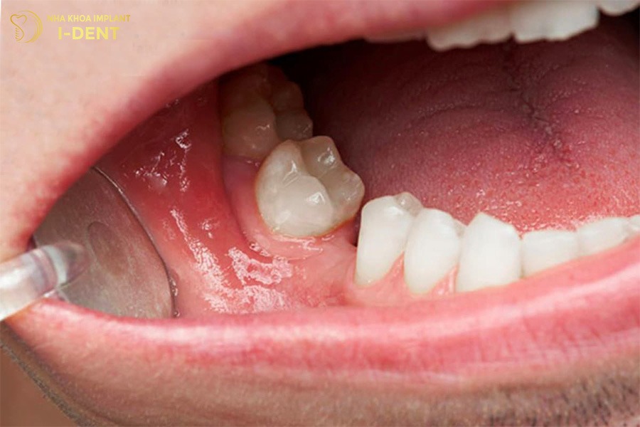 Mất răng số 6 lâu năm làm yếu các răng bên cạnh.