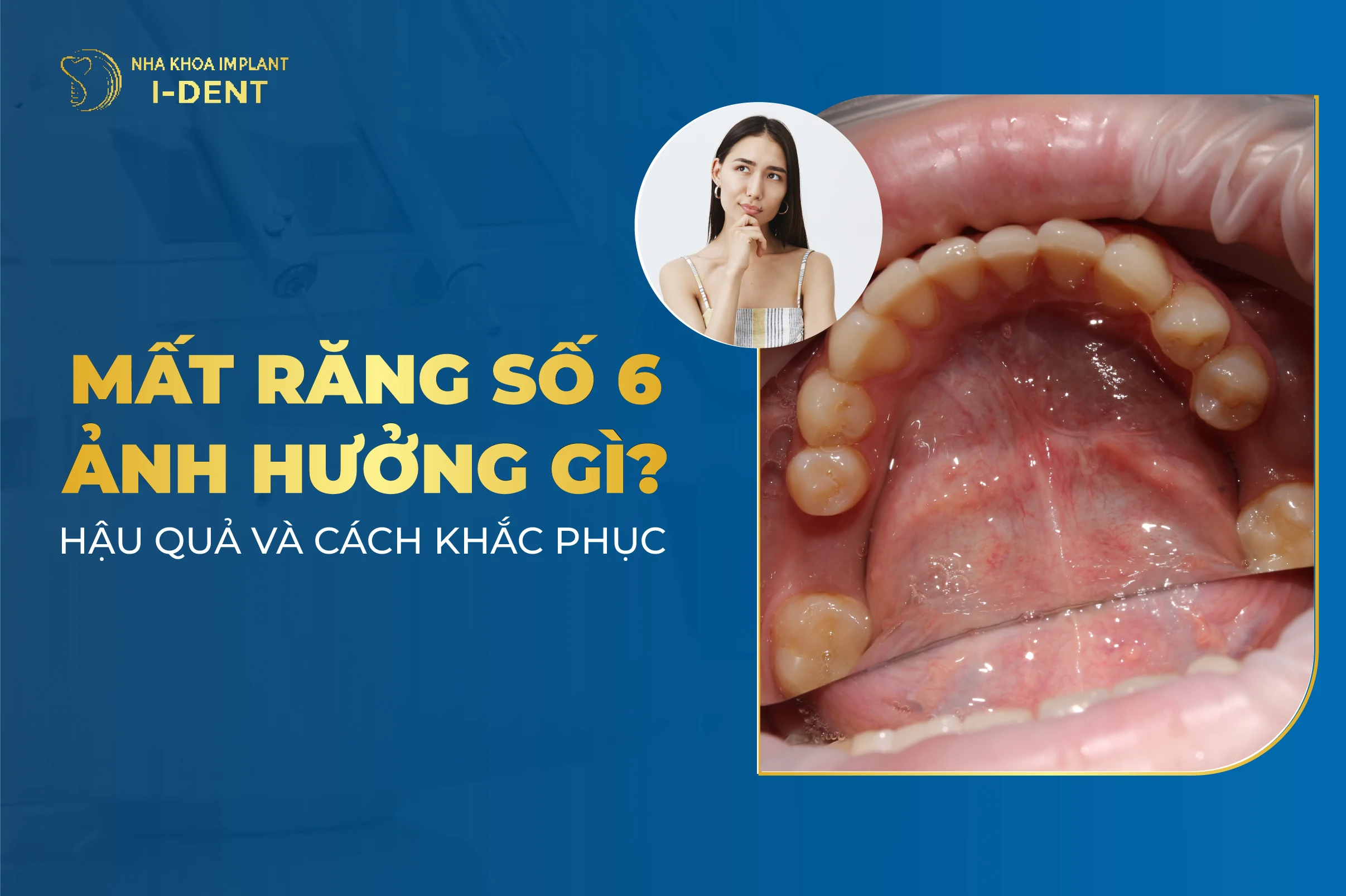Mat Rang So 6