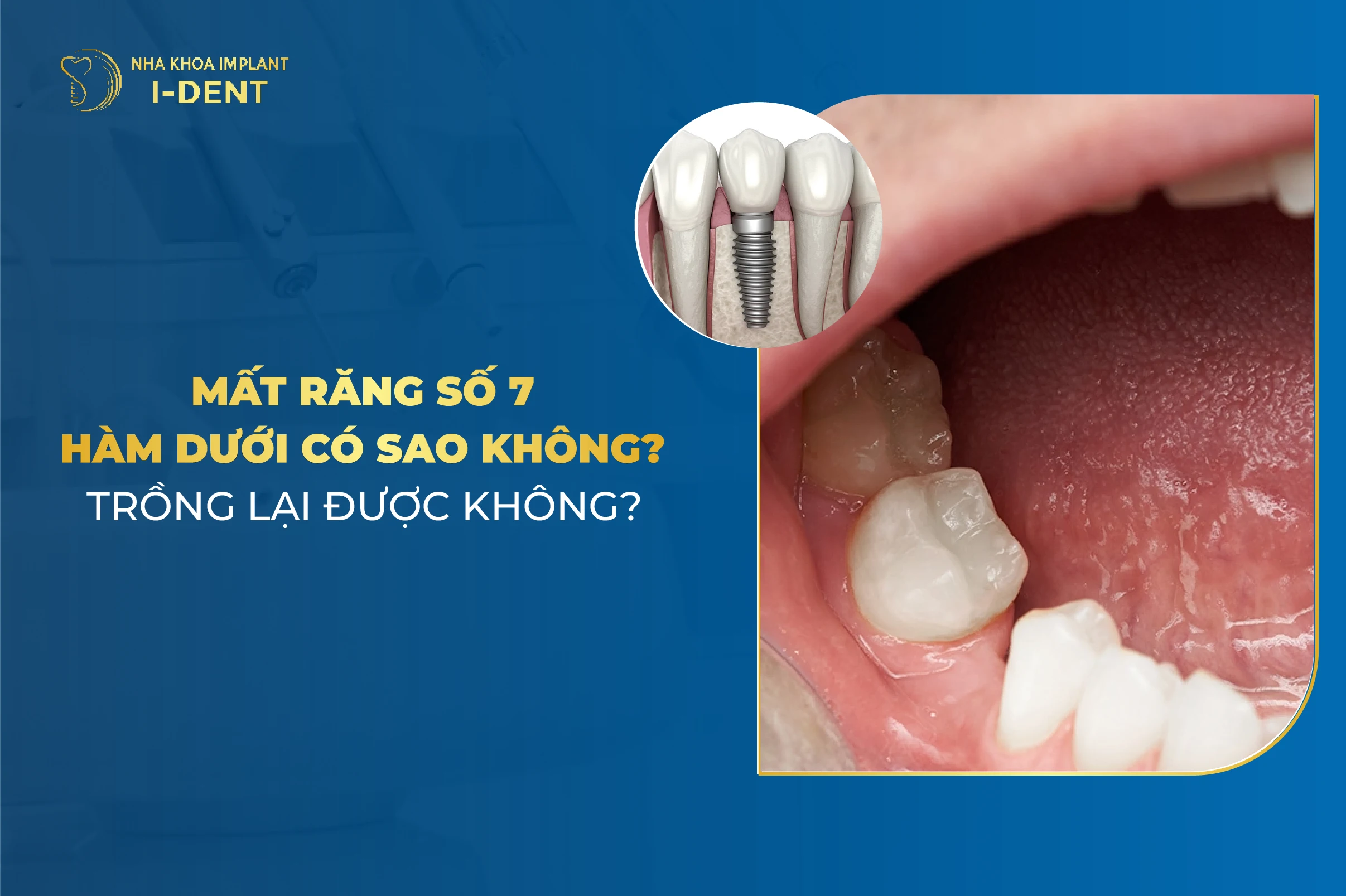 Mat Rang So 7 Ham Duoi Co Sao Khong