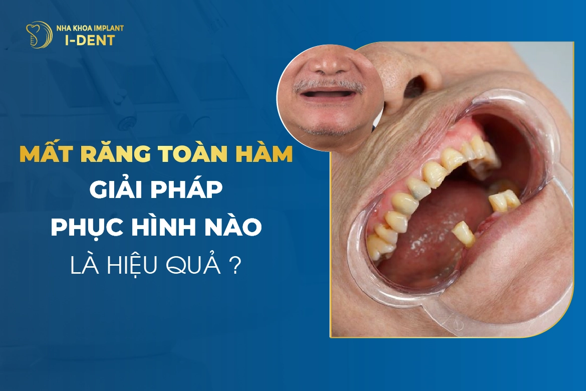Mat Rang Toan Ham