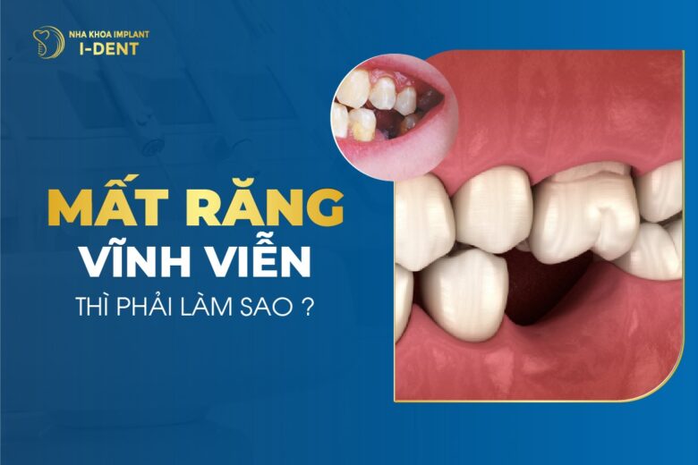 Mất Răng Vĩnh Viễn Nên Làm Gì? Cách Phòng Ngừa Mất Răng