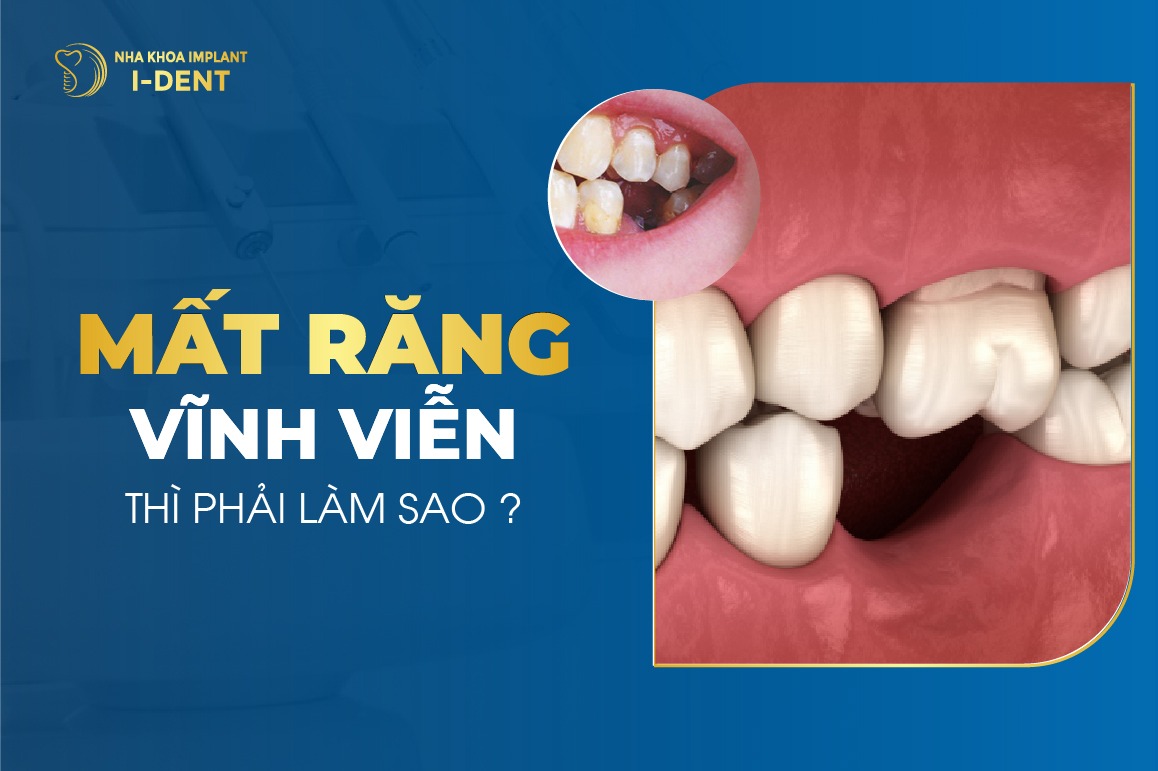 Mat Rang Vinh Vien Thi Phai Lam Sao