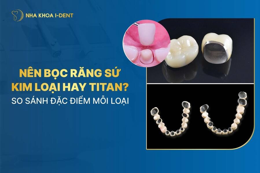 Nen Boc Rang Su Kim Loai Hay Titan