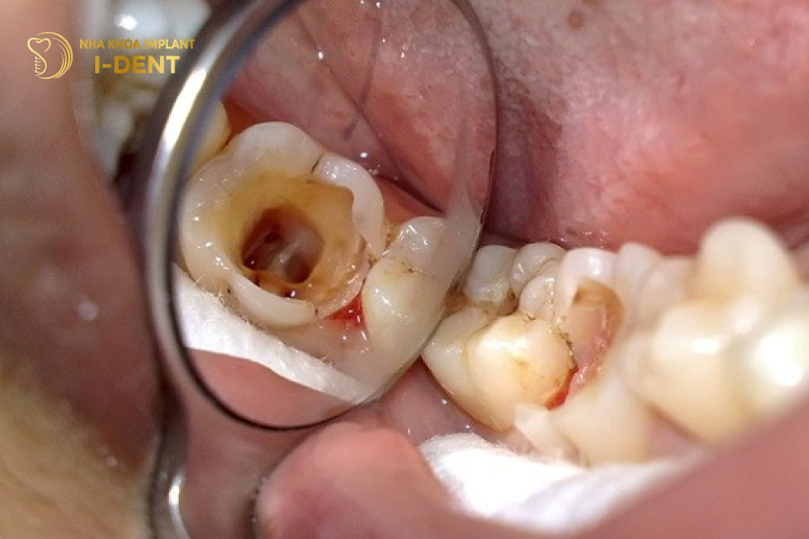 Tình trạng răng chết tủy