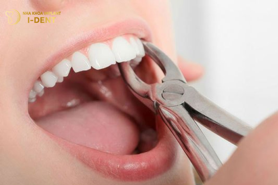 nhổ răng bao lâu thì cấy implant