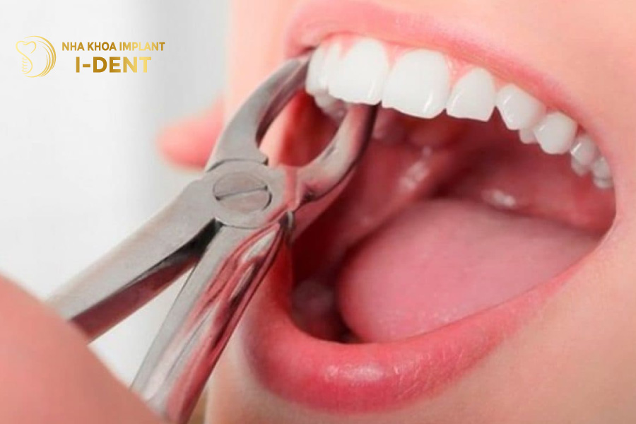 mất răng bao lâu thì bị tiêu xương