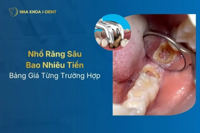 Bảng Giá Nhổ Răng Sâu 2026: Chi Phí Từng Loại Răng