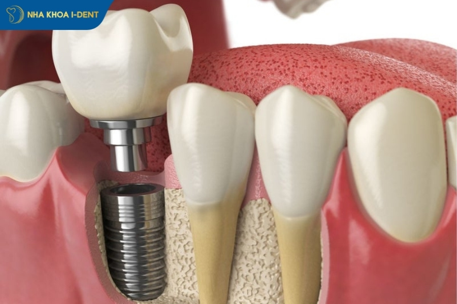 nhổ răng số 7 hàm dưới có nguy hiểm không