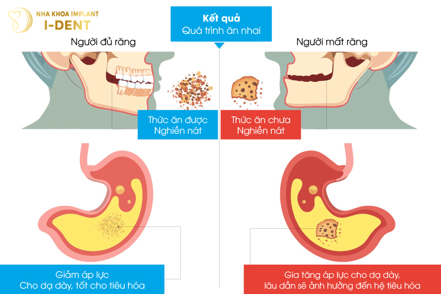 nhổ răng không trồng lại có sao không