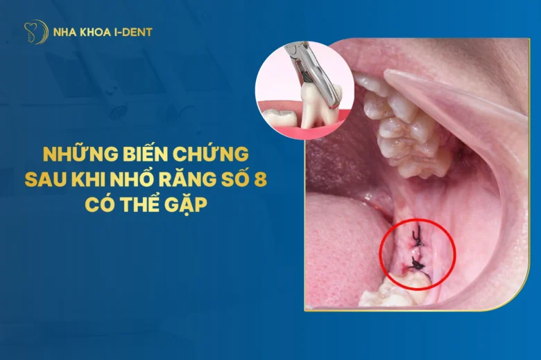 Những Biến Chứng Sau Khi Nhổ Răng Số 8 Có Thể Gặp Và Cách Điều Trị