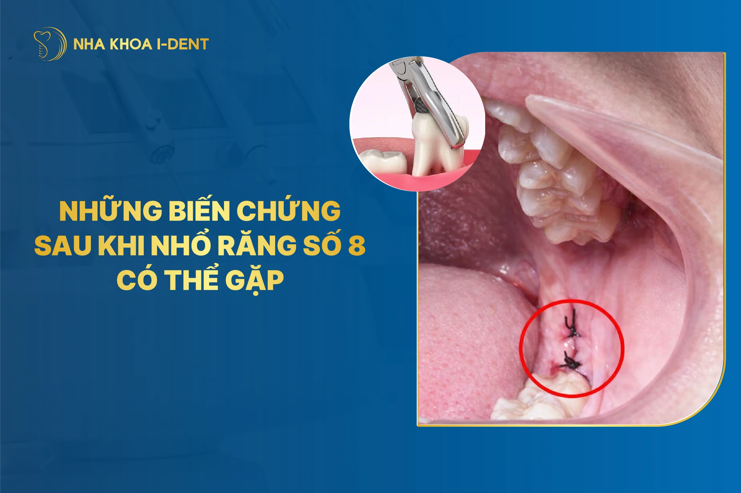 Nhung Bien Chung Sau Khi Nho Rang So 8