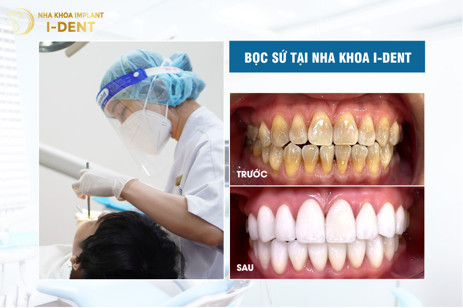 Răng sứ giúp khắc phục hiệu quả nhiều khuyết điểm răng miệng