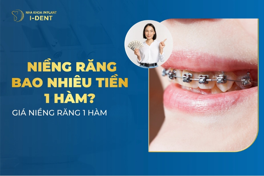 Niềng Răng Bao Nhiêu Tiền 1 Hàm