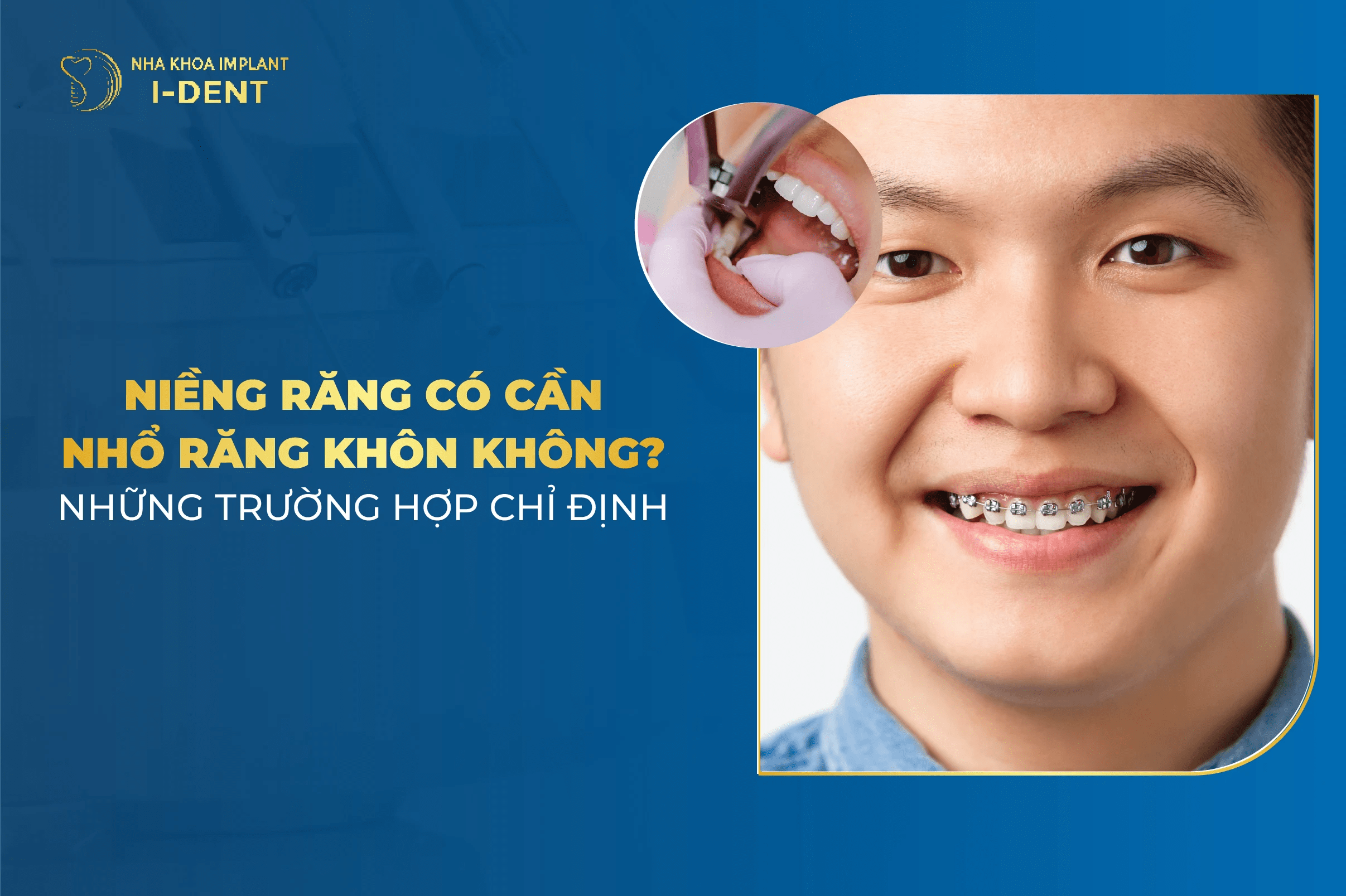 Nieng Rang Co Can Nho Rang Khon Khong 1