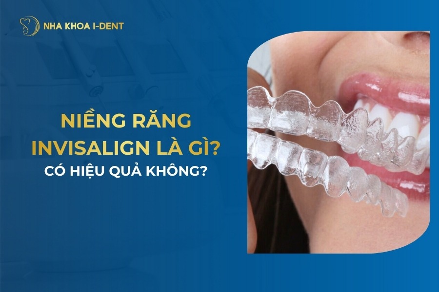 Nieng Rang Invisalign La Gi