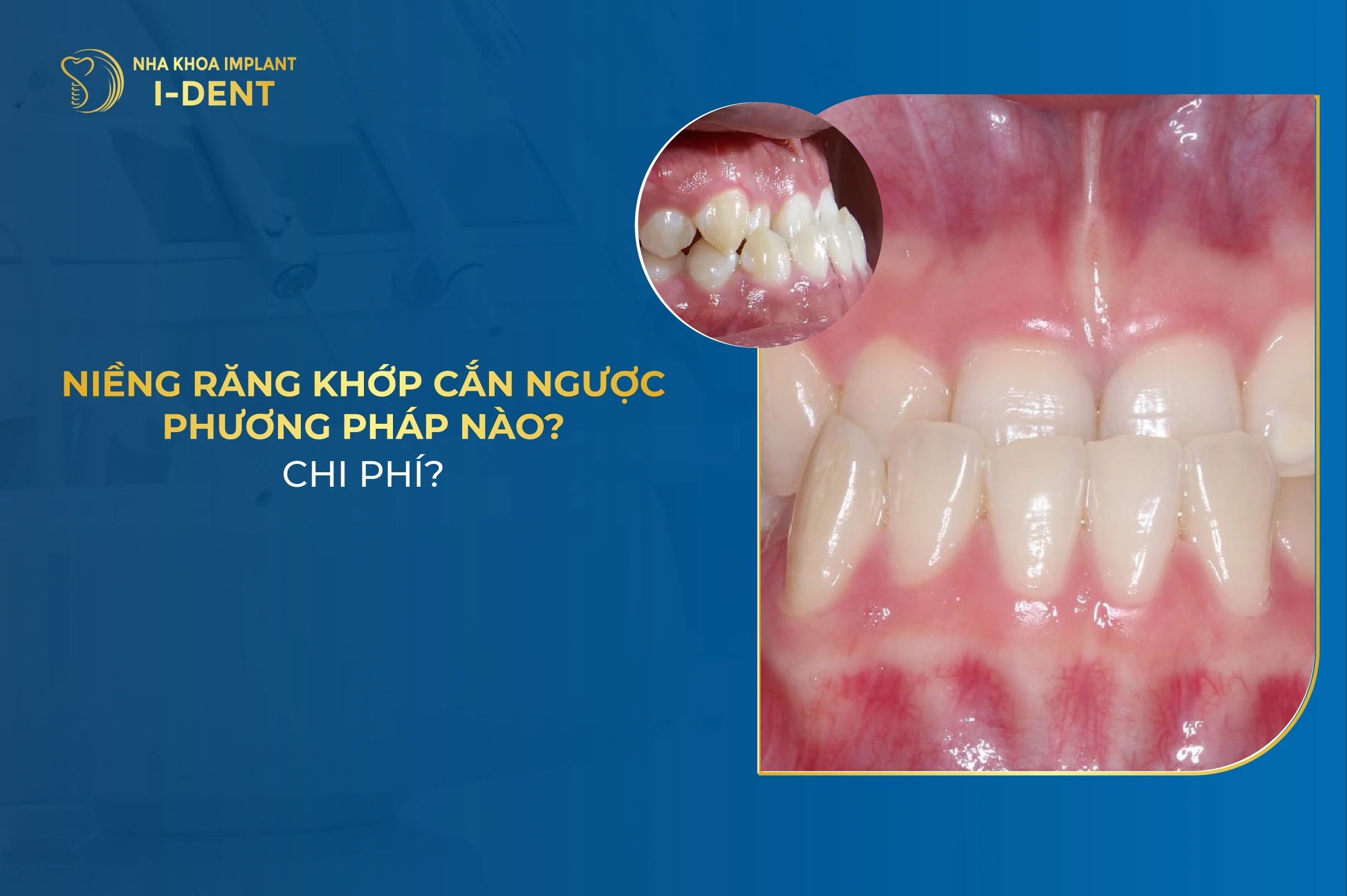 Nieng Rang Khop Can Nguoc