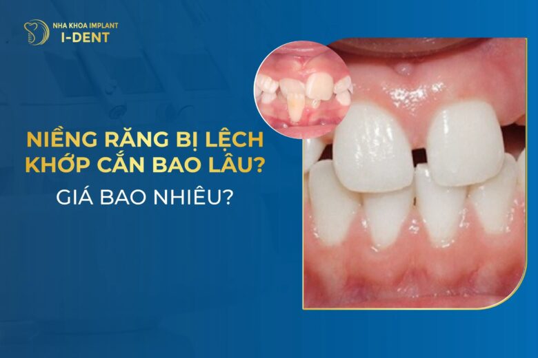Niềng Răng Lệch Khớp Cắn Bao Nhiêu Tiền? Mất Bao Lâu?