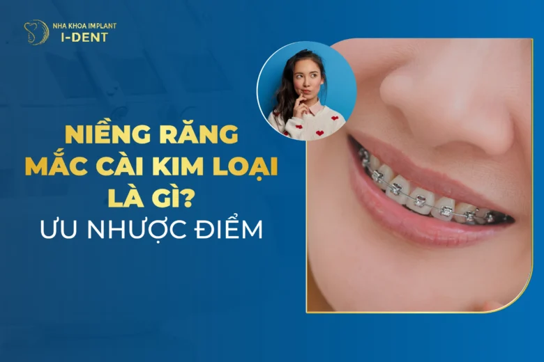 Niềng Răng Mắc Cài Kim Loại Là Gì? Chi Phí, Ưu Điểm, Quy Trình