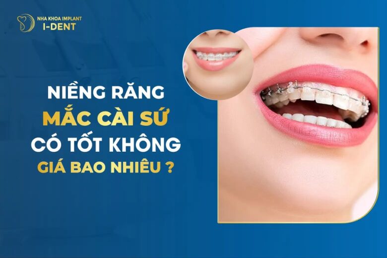 Niềng Răng Mắc Cài Sứ Là Gì? Giá Và Ưu Nhược Điểm