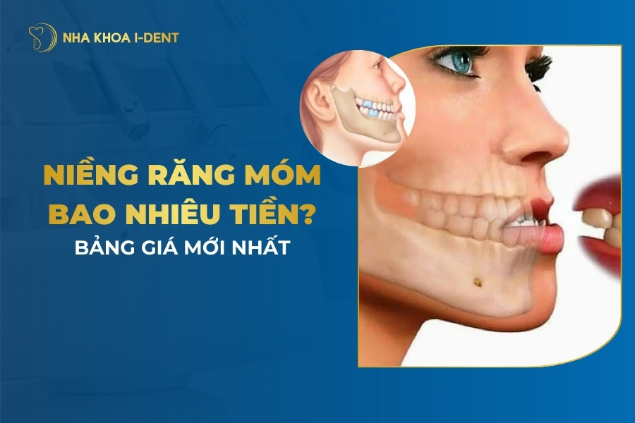 Niềng Răng Móm Bao Nhiêu Tiền