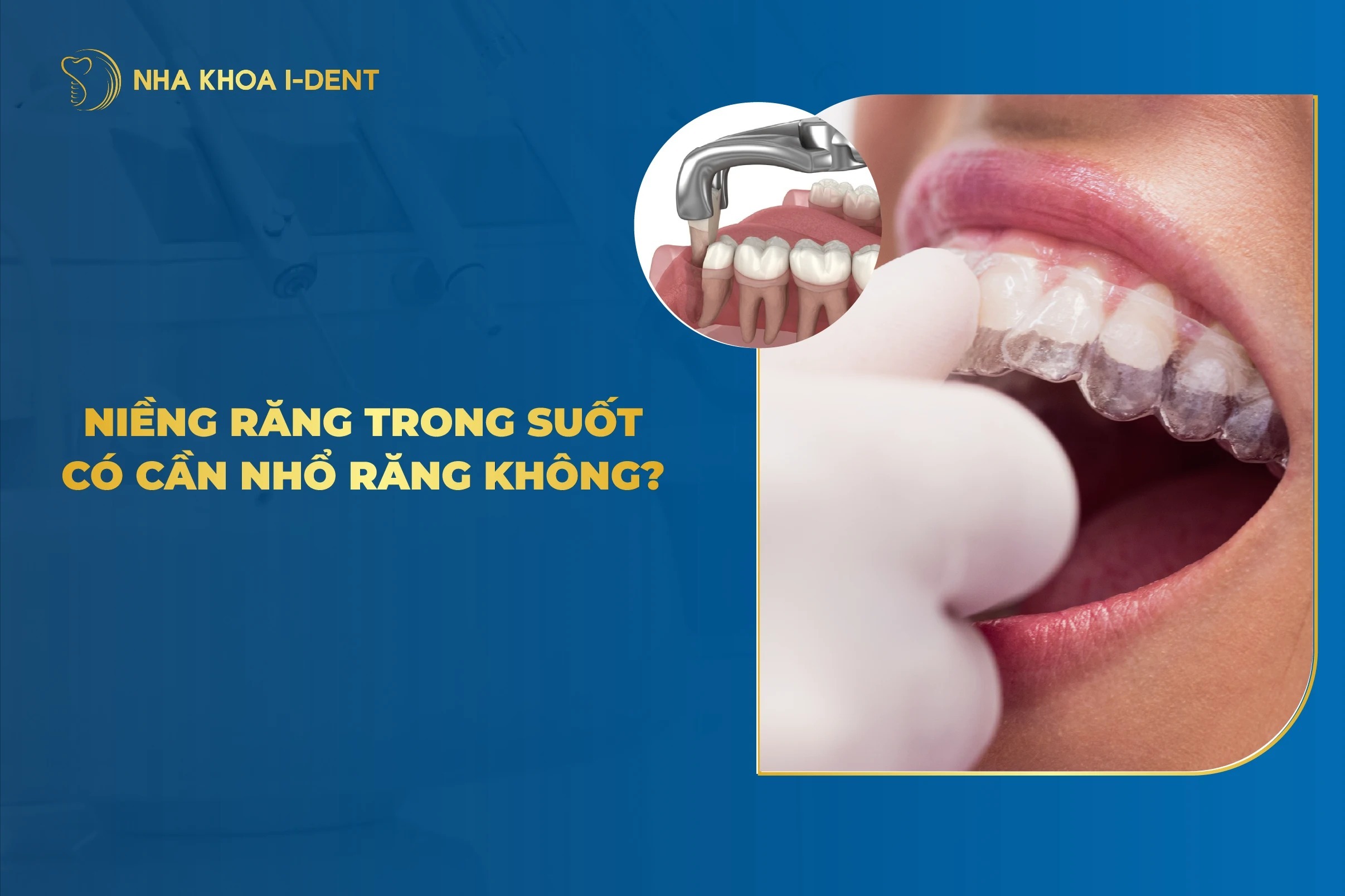 Nieng Rang Trong Suot Co Can Nho Rang Khong