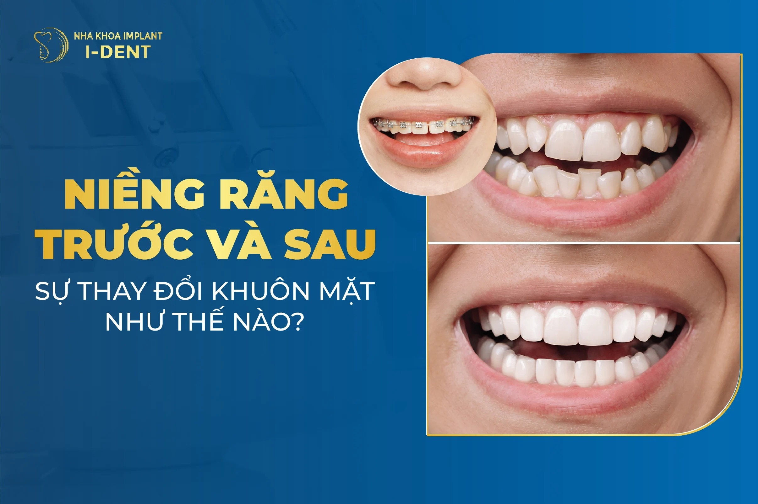 Nieng Rang Truoc Va Sau
