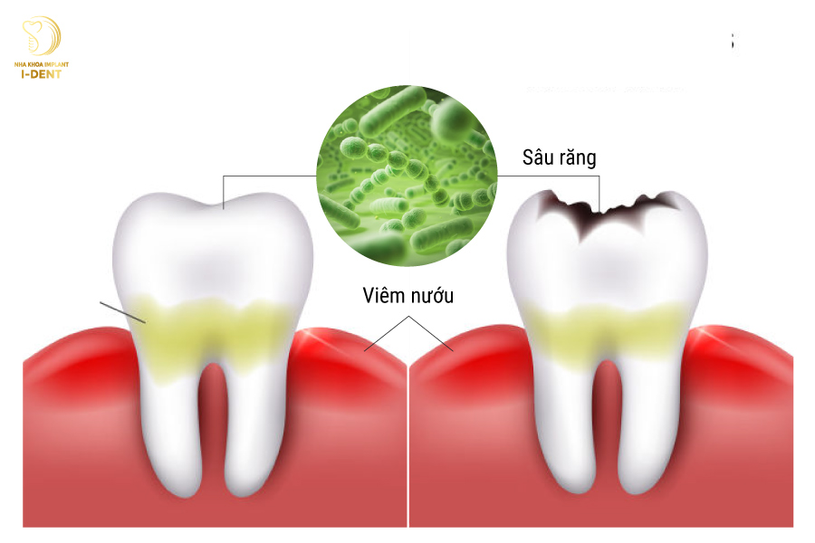 Nướu sưng hoặc chảy máu Nướu sưng hoặc chảy máu