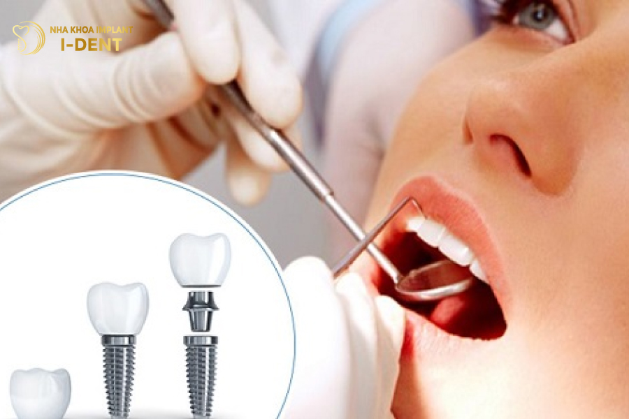sau khi nhổ răng bao lâu thì trồng implant