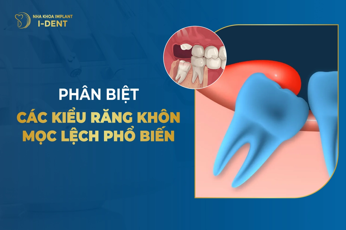 Phan Biet Cac Kieu Rang Khon Moc Lech Pho Bien