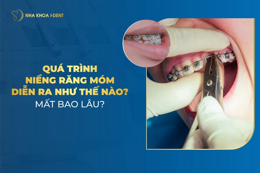 Qua Trinh Nieng Rang Mom