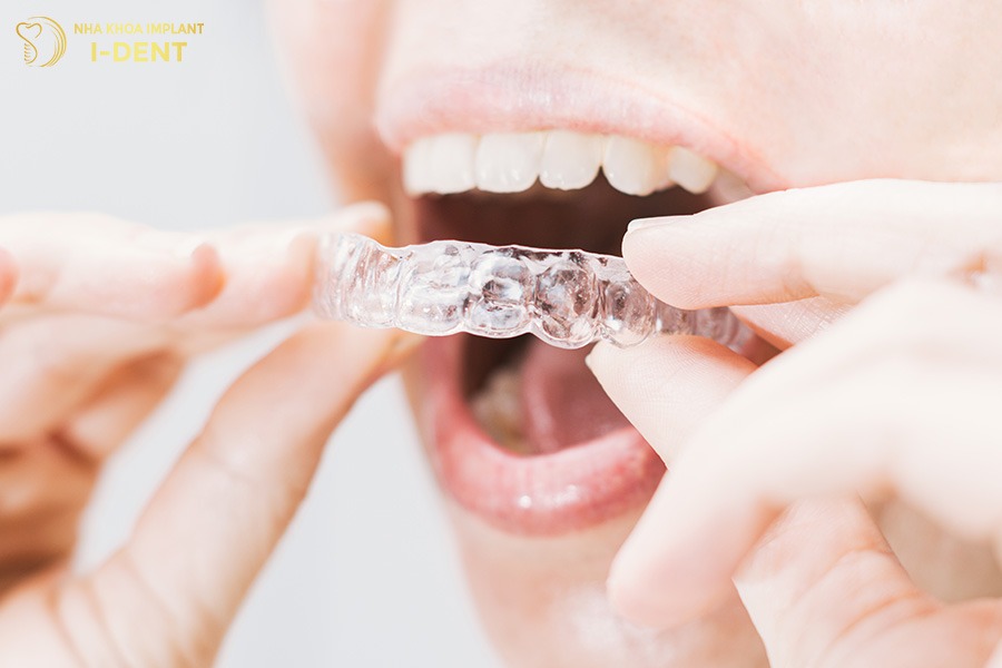 quy trình niềng răng trong suốt