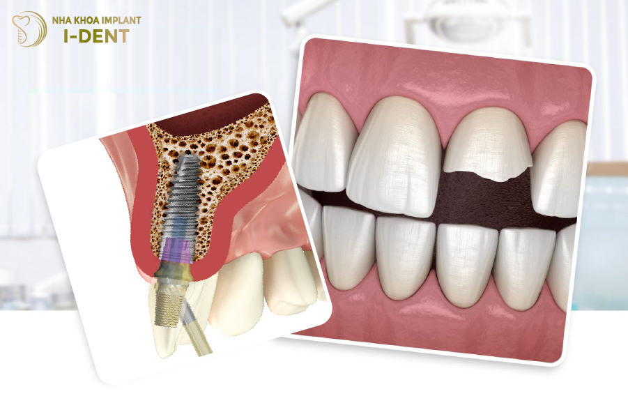 Răng bị bể lớn phải tiến hành nhổ và trồng răng implant Răng bị bể lớn phải tiến hành nhổ và trồng răng implant