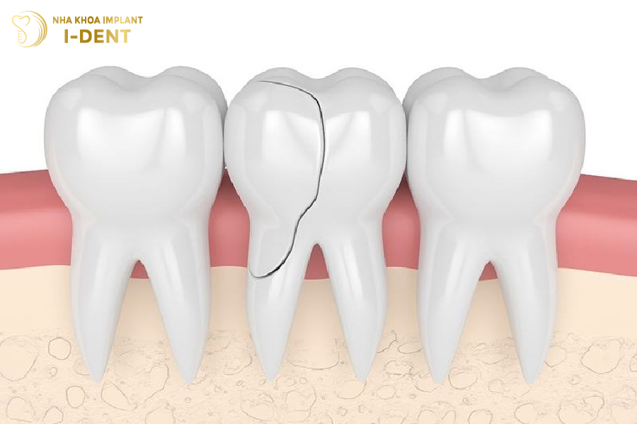 bị rụng răng có sao không