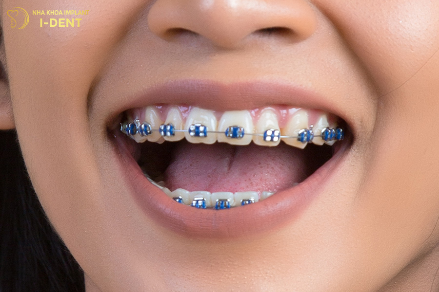 niềng răng hô nhẹ
