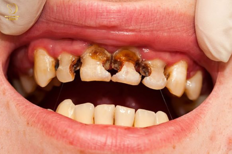 Răng bị sâu nên bọc răng sứ