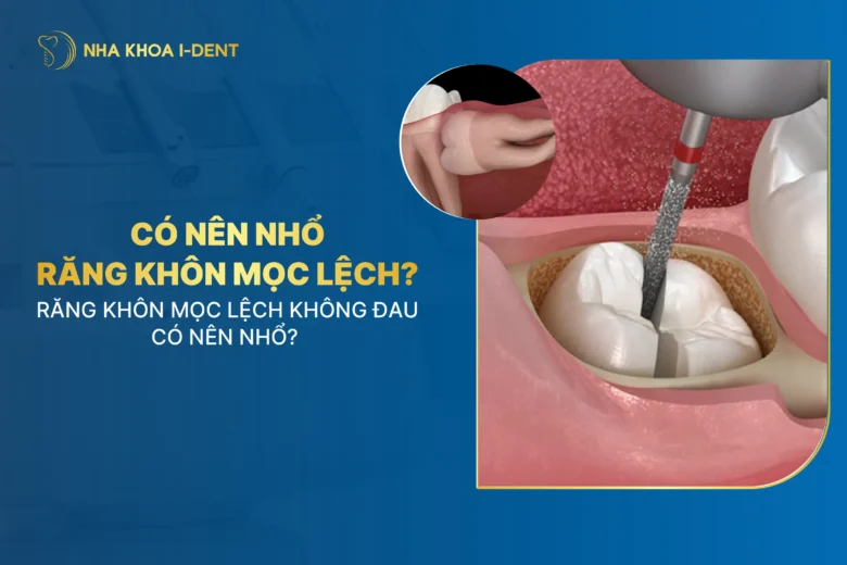 Răng Khôn Mọc Lệch Có Nên Nhổ Không? Có Sao Không?