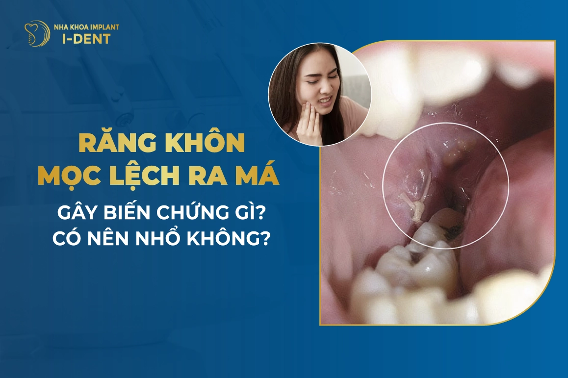 Rang Khon Moc Lech Ra Ma Gay Bien Chung Gi
