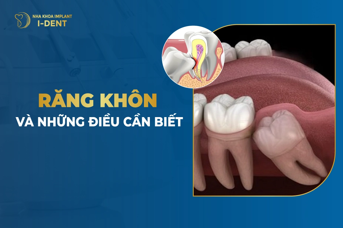 Rang Khon Va Nhung Dieu Can Biet