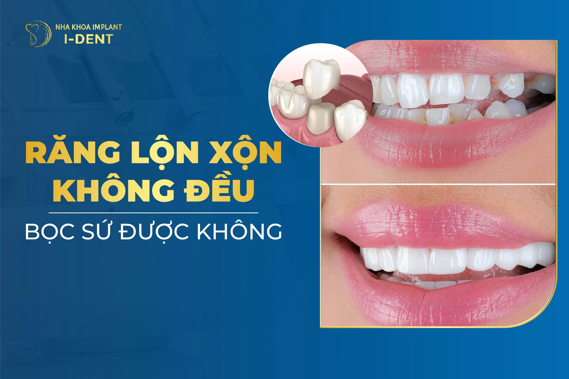 Rang Moc Lech Co Boc Duoc Khong